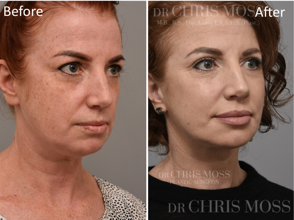 Facelift Before and After