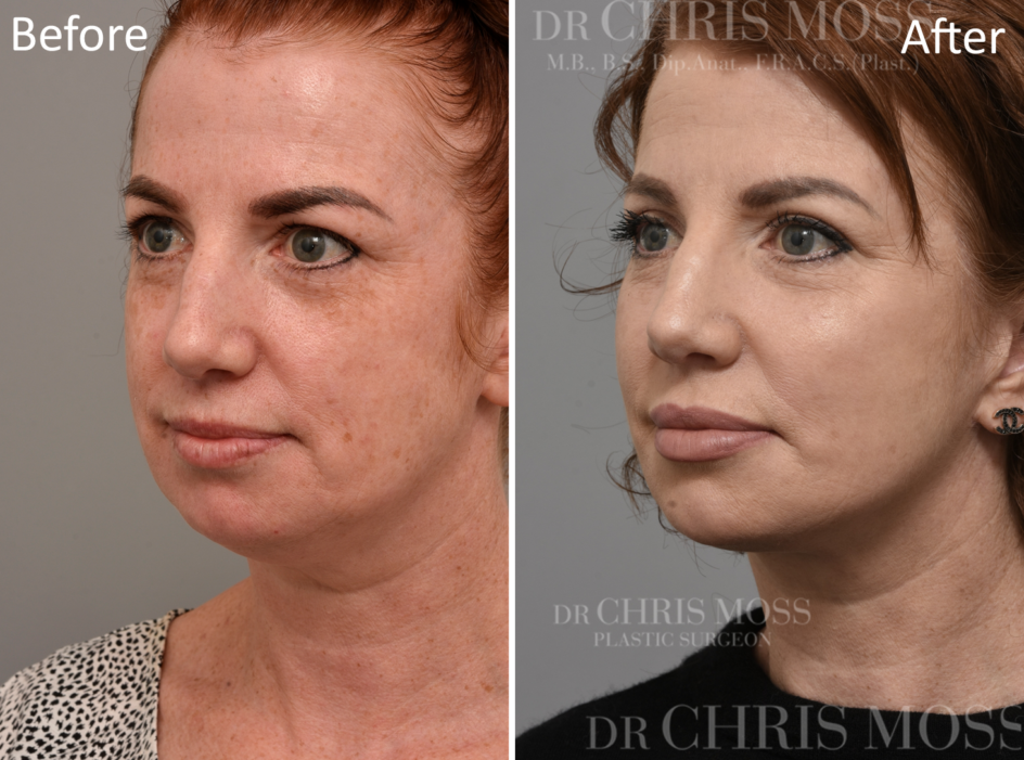 Before and After Facelift