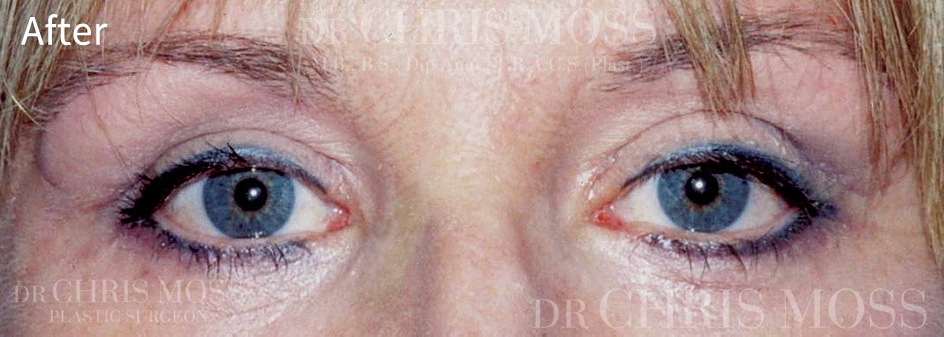 Blepharoplasty0321-after