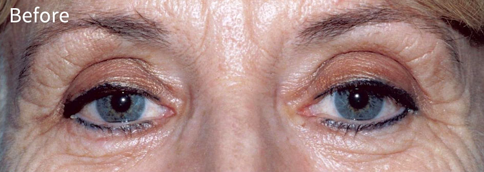 Blepharoplasty0321-before