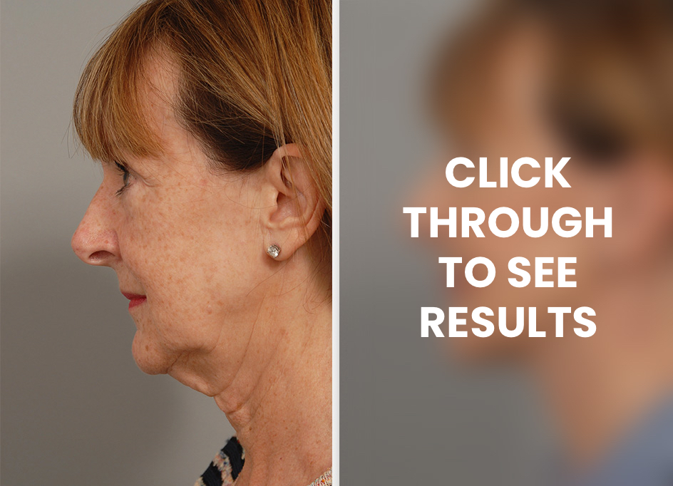 Face and Neck Lift, Before and After, Dr Chris Moss Home