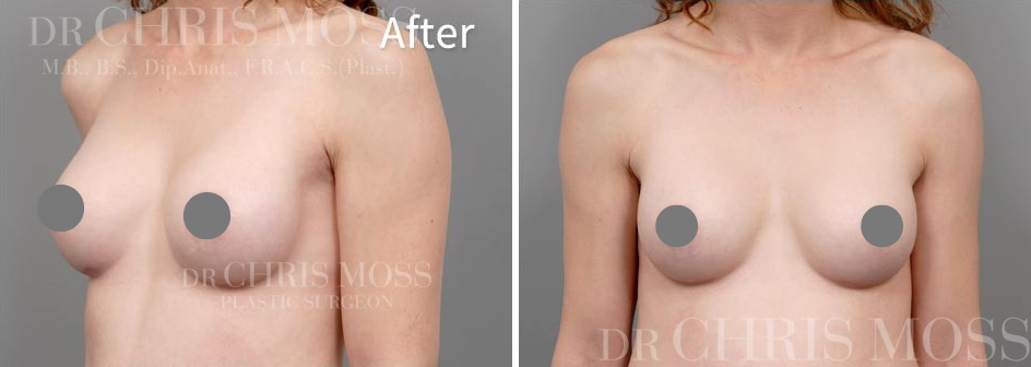 Breast Patient After