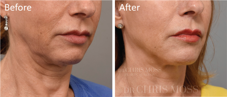 Neck Lift Melbourne, Before and After (profile) - Dr Chris Moss 6