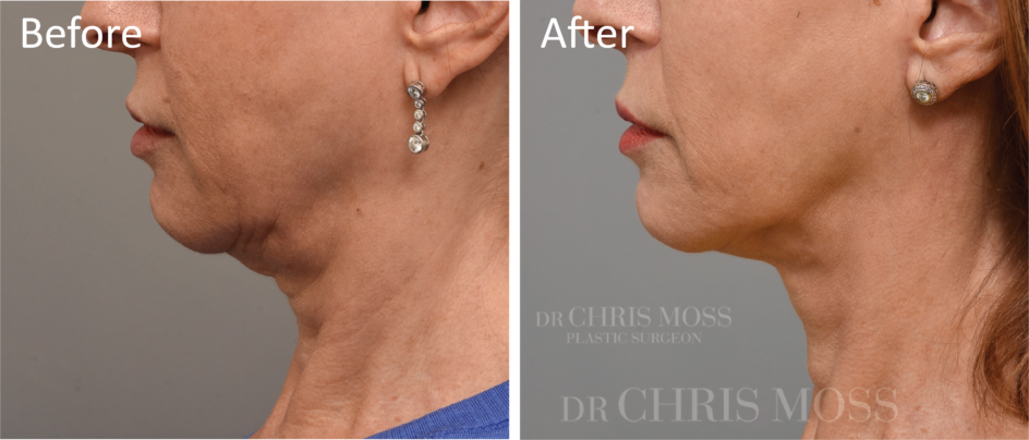 Neck Lift Melbourne, Before and After (profile) - Dr Chris Moss 6A