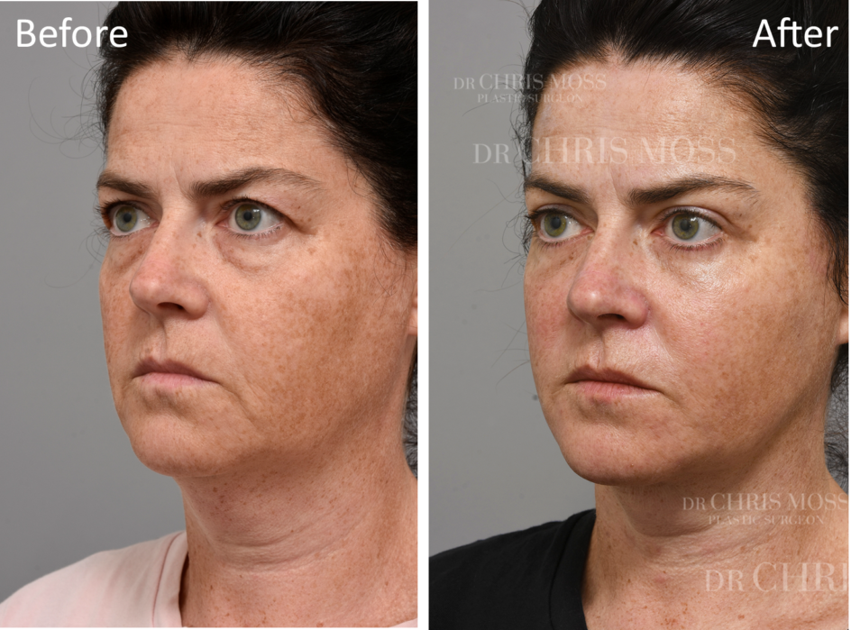 Facelift and NeckLift Result