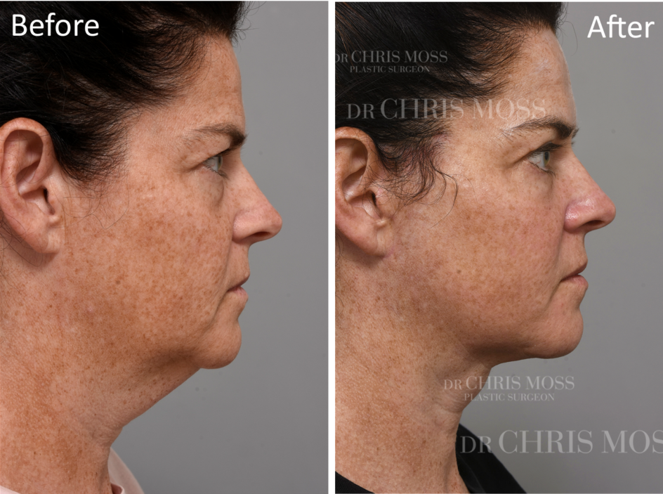 Facelift and NeckLift