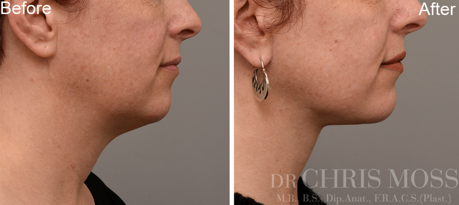 Neck Lift Melbourne, Before and After (profile) - Dr Chris Moss 5