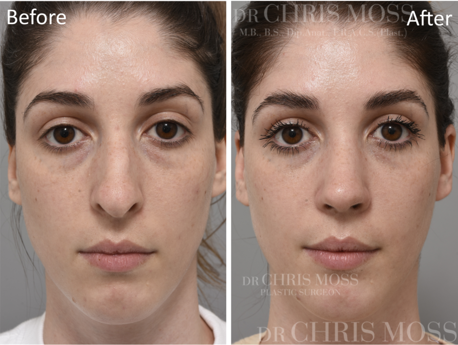 Rhinoplasty Before and After (oblique) - Dr Chris Moss 3