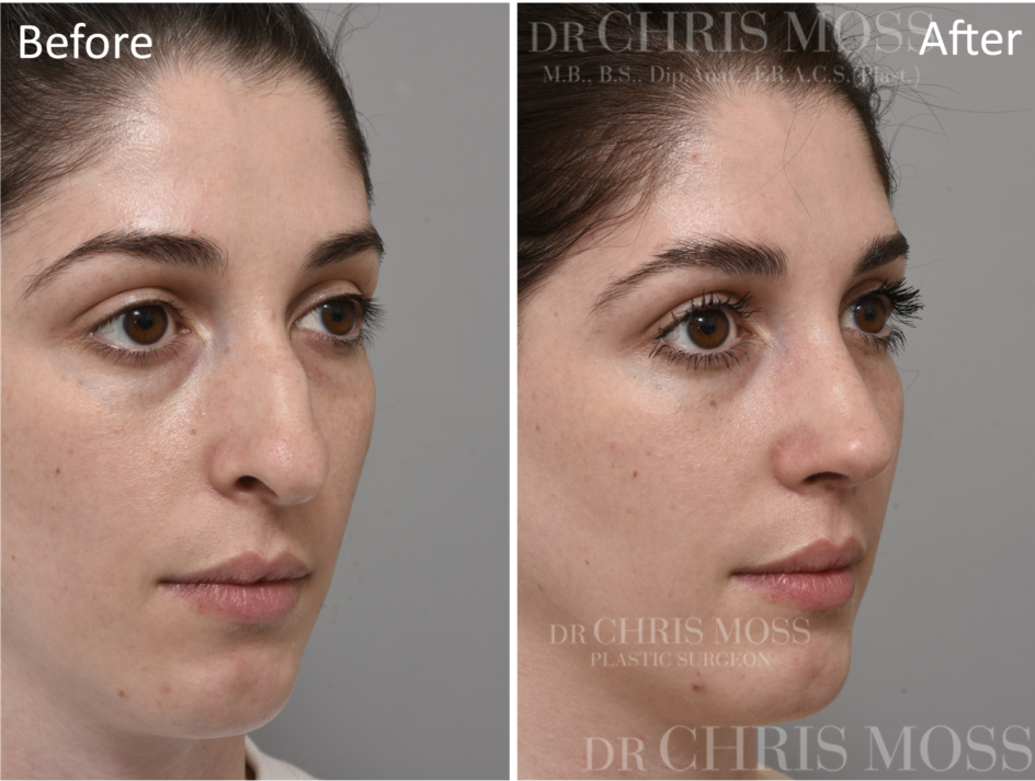 Rhinoplasty Before and After (oblique) - Dr Chris Moss 3
