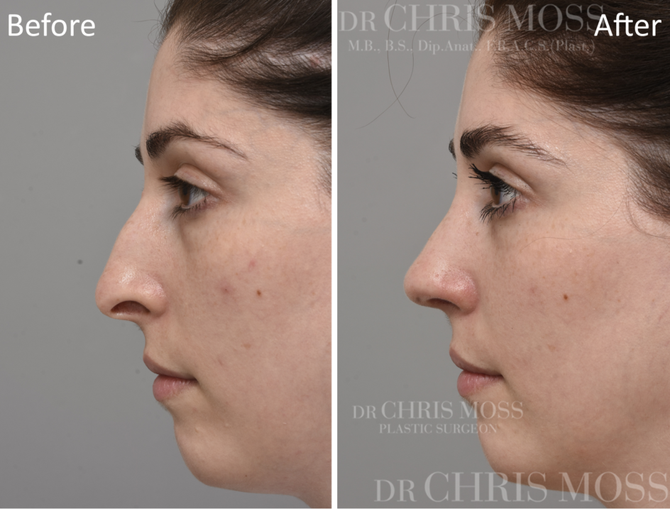 Rhinoplasty Before and After (oblique) - Dr Chris Moss 3