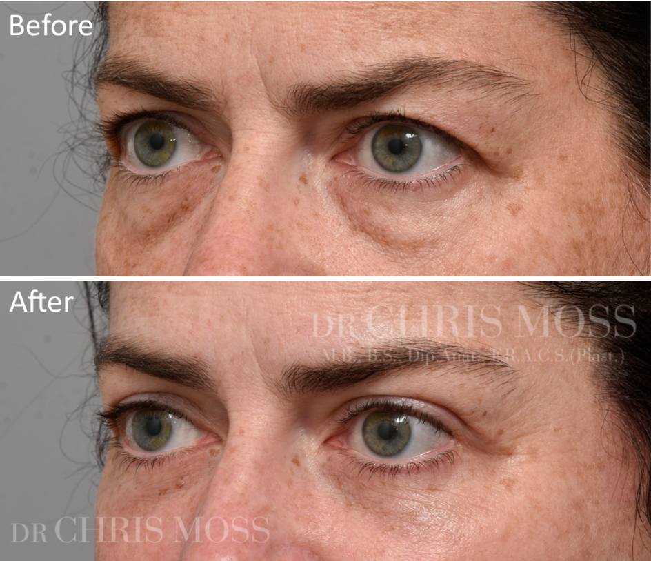 Eyelid Surgery (Blepharoplasty) Melbourne Before and After (oblique) - Dr. Chris Moss 4